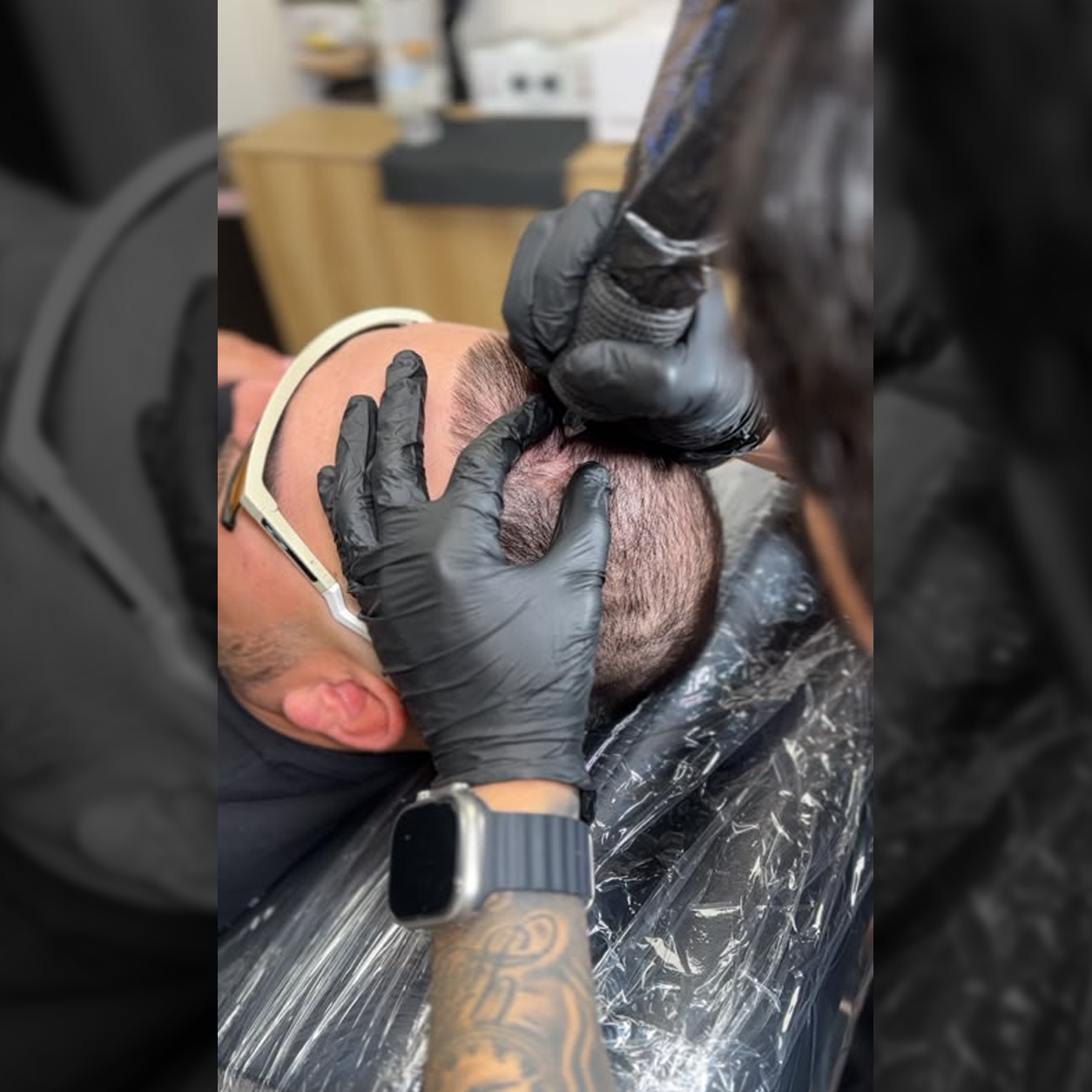 Scalp Micropigmentation Services